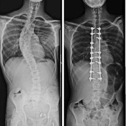 Bel kısmında skolyozu olan hastamın ameliyat öncesi ve sonrası skolyoz filmleri #Skolyoz her zaman üç ana düzlemde (3D) yani önden yanal eğrilik, sagitalde normalden ön veya arka (çoğunlukla lordotik) yöne sapma ve yatay düzlemde (çok karakteristik olarak) vertebral eksenel rotasyon içeren karmaşık bir deformitedir.  Scoliosis is a multifactorial three-dimensional (3D) spinal